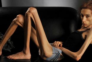 吃疾病:厌食症神经症 - 最致命的精神疾病