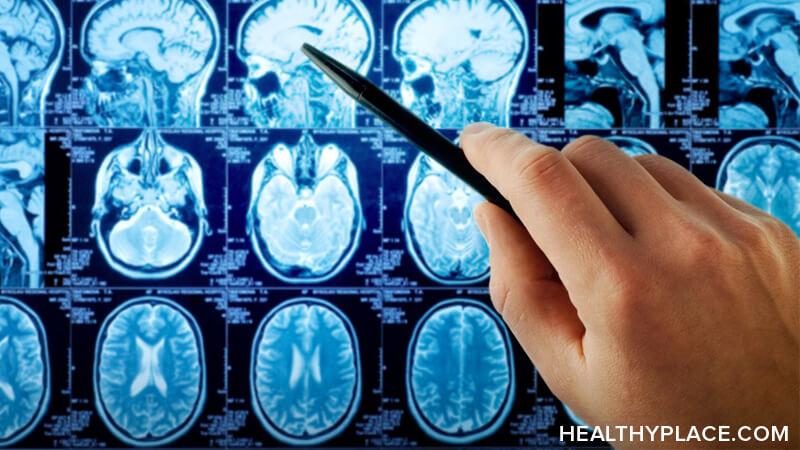 Relationship Between Head Injury and Anxiety Proven to Exist 头部受伤会导致焦虑。我们这些患有创伤性脑损伤的人也怀疑过,但现在已经被证实了。在HealthyPlace了解关于头部损伤和焦虑的最新研究。脑震荡确实会引起焦虑,原因如下。