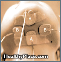 刺激强度和电极放置对电静脉疗法（ECT）疗效和认知效果的影响。