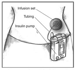 胰岛素泵