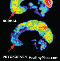 精神病患者的大脑一直是研究的兴趣领域试图确定精神病患者的思维方式但精神病患者的大脑有多不同呢?