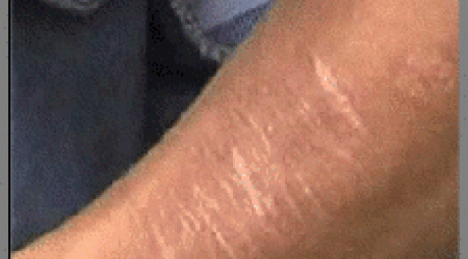 切割是一种处理我的抑郁症
