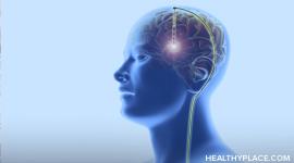 深脑刺激是一种手术治疗的形式。它可以对治疗脑疾病有效，但风险是什么？在健美的地方找出来。