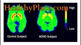 ADD和ADHD这两个词可以互换使用。然而，根据第四版DSM，最新的术语是ADHD(注意缺陷多动障碍)。