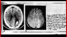 神经学家约翰·弗里德伯格讲述了精神药物和电击如何损害大脑。他说，所有人都会遭受一些脑损伤和失忆。